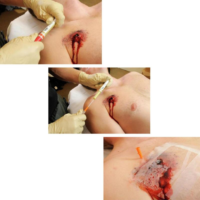 TPAK dekompresjonsnål 14 GA3,25 Sterile